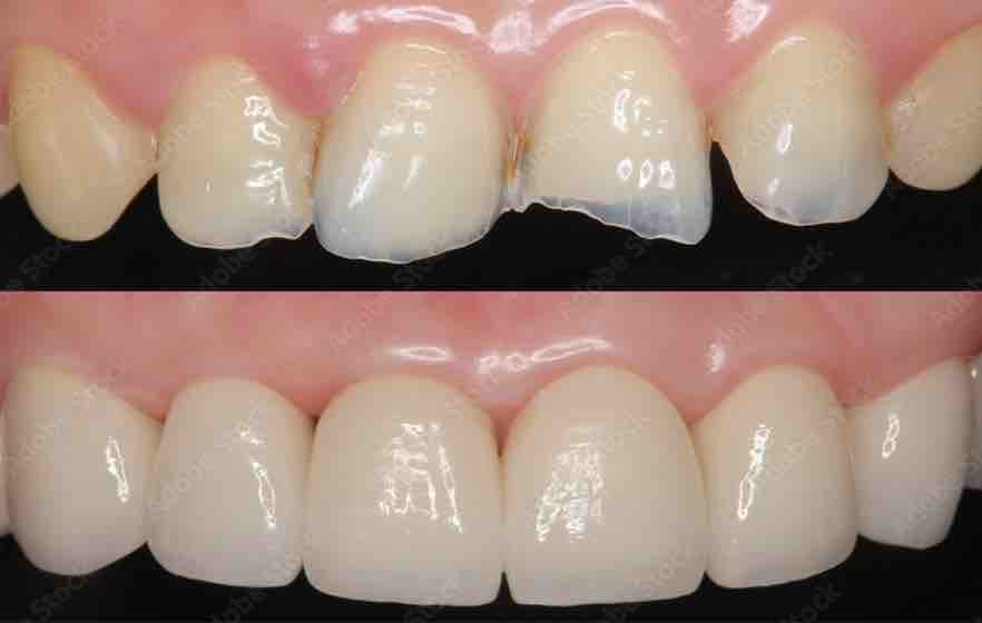 antes-dentes.jpg